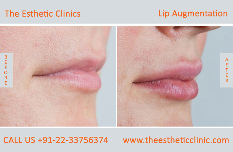 Lip Augmentation, Lip Enlargement, Lip Implant Surgery before after photos in mumbai india (3)